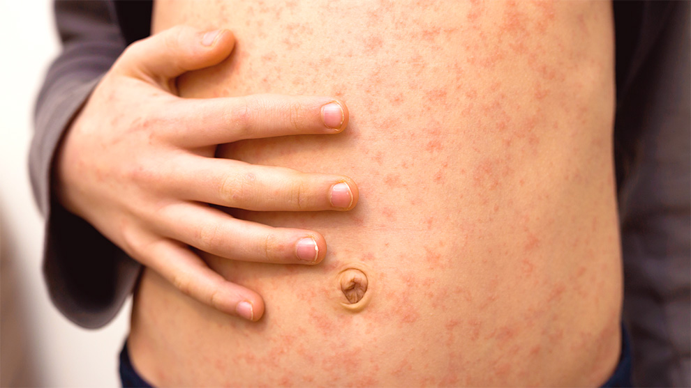 México concentra el mayor número de casos confirmados en 2025, con 5,019 contagios reportados por la Organización Panamericana de la Salud (OPS).