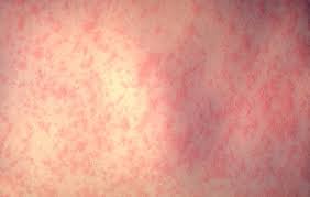 La Organización Mundial de la Salud advierte que los malentendidos y la desinformación sobre las vacunas contra el sarampión están provocando el resurgimiento de brotes y muertes evitables en varios países, y llama a reforzar la confianza en la inmunización.